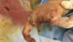 Tưởng lựu đạn giả cầm chơi, người phụ nữ bị nát bàn tay