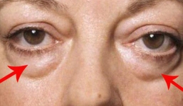 Rất nhiều người có cái 'túi mỡ' này dưới mắt nhưng nguyên nhân do đâu thì không phải ai cũng biết