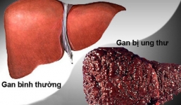 3 nhóm người có nguy cơ mắc ung thư gan cao nhất: Đừng để phát hiện khi ở giai đoạn muộn