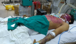 Tự ý mua thuốc điều trị khi mắc thủy đậu, nam thanh niên nguy kịch tử vong