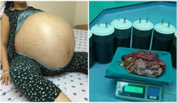 Người phụ nữ 'mang thai' khối u lớn nhất Việt Nam nặng tới 48kg