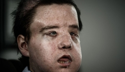 “Người đàn ông có 3 khuôn mặt” - Người được cấy ghép 2 khuôn mặt đầu tiên trên thế giới!