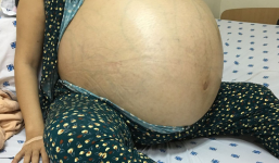 6 giờ ròng rã cứu mạng người phụ nữ mang khối u buồng trứng lớn nhất Việt Nam