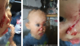 Trung Quốc: Em bé 1 tuổi đang chơi ngoài công viên thì bị flycam sà xuống chém trúng mặt