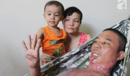 Bị điện giật cháy người không có tiền chạy chữa, bố xót xa nhìn con trai 4 tuổi không nhận ra mình