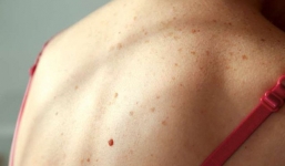 Chế độ ăn có những thực phẩm này sẽ giúp chống nắng, ngăn chặn ung thư da nếu thực hiện đều đặn vào mùa hè