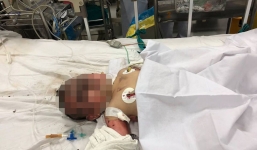 Nổ bình gas mini, mẹ bầu 4 tháng và con gái 15 tháng tuổi bị bỏng nặng