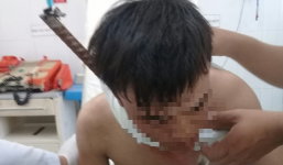 Nam công nhân bị cây sắt đâm xuyên từ cổ xuống ngực