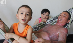 Gia đình người bố bị điện giật cháy người, tới mức con trai không thể nhận ra đã nhận được 140 triệu tiền ủng hộ