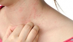 Dị ứng thời tiết vào mùa hè: Bất kể ai cũng có thể gặp phải và những lưu ý từ chuyên gia nhất định không được bỏ qua