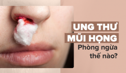 Đây là dấu hiệu sớm nhất của bệnh ung thư mũi họng: Cần nắm rõ để phòng bệnh kịp thời