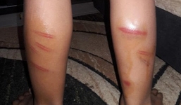 Cha bật khóc nức nở khi nhìn thấy đôi chân in hằn đầy vết roi của con trai 8 tuổi