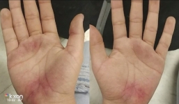 Mỹ: Con đi học về với đôi bàn tay trầy trụa, mẹ báo nhà trường và cảnh sát vào cuộc điều tra ngay lập tức