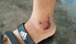 Trung tá công an bị khỉ đuôi lợn tấn công 