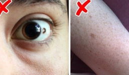 Nốt ruồi ai cũng có nhưng 5 chuyện hoang đường này sẽ khiến nhiều bạn ngỡ ngàng