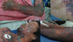 Thêm một bệnh nhân tử vong do nhiễm khuẩn liên cầu lợn