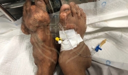 Long An: Người đàn ông bị biến dạng cơ thể nặng vì uống thuốc giảm đau trôi nổi suốt 10 năm trời