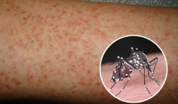 20.500 ca mắc, 4 trường hợp tử vong do sốt xuất huyết: cảnh báo nguy cơ mắc sốt xuất huyết và việc cần làm ngay để đề phòng