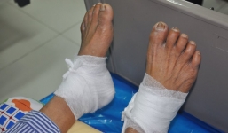 Bỏng nặng, hoại tử gót chân do đắp lá ngải cứu rang nóng chữa chứng tê bì