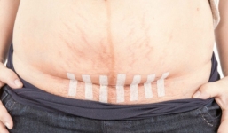 Câu chuyện đặc biệt của những bà mẹ sinh mổ với những vết sẹo dài: Mọi phụ nữ đều nên đọc!