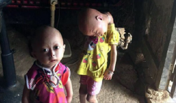 Niềm vui và hi vọng đã đến với 2 bé gái bị nghẹo đầu tựa 'người ngoài hành tinh' ở Tuyên Quang