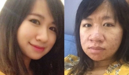 Bức ảnh lột tả nhan sắc 'một trời một vực' của bà mẹ trẻ khi mang bầu: Mụn nổ đầy mặt, mũi nở gấp đôi, người đầy vết rạn và thâm