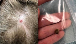 Chỉ vì một vết côn trùng cắn nhỏ xíu trên đầu, bé 5 tuổi bị liệt và không thể nói suốt 12 giờ