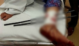 Cấp cứu cụ bà bán vé số bị 2 thanh sắt đâm xuyên chân