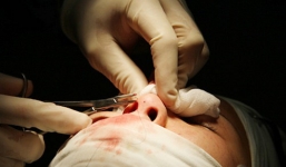 Clip cận cảnh quá trình phẫu thuật nâng mũi: Hãy thử xem có đáng sợ không?