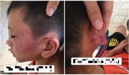 Xác minh thông tin bé trai 12 tuổi bị mẹ kế đánh đập tàn nhẫn phải nhập viện ở Nghệ An