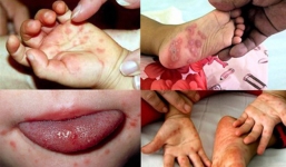 Hà Nội: Nguy cơ bùng phát dịch tay chân miệng rất lớn, 6 điều cha mẹ không được bỏ qua