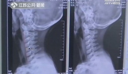 Cảnh báo: Bé 9 tuổi biến dạng xương cổ do xem điện thoại, cha mẹ phát hiện thì đã quá muộn