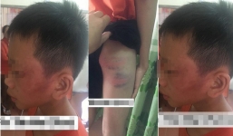 Vụ cháu bé 12 tuổi bị bạo hành đến nhập viện: Mẹ kế khai gì tại cơ quan?