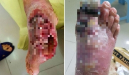 Hà Nội: Bác sĩ phải cắt lọc thịt bàn chân hoại tử cứu sống bệnh nhân tự ý chữa tiểu đường