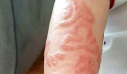 Hai đứa trẻ đau đớn khi tay, lưng sưng tấy do vẽ henna trong chuyến du lịch và lời cảnh báo nhiều phụ huynh bỏ qua