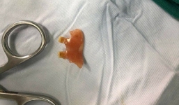 Ho dai dẳng, đi khám viêm phổi mới phát hiện ra thứ kinh khủng mắc kẹt trong phổi