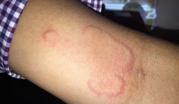 Hi hữu: Về quê nghỉ hè, bé gái bị giun bò lúc nhúc dưới da