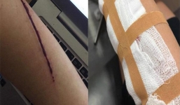 Xôn xao hình ảnh cô gái bị rạch tay cướp tài sản ở Hà Nội