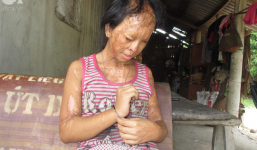 Bé gái bị tạt axit năm 7 tuổi vì mẹ 'giật chồng' người khác: Con từng nghĩ sẽ không sao, nhưng giờ con biết con bị mù thật rồi