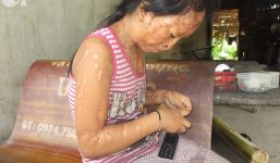 Bé gái bị tạt axit năm 7 tuổi vì mẹ 'giật chồng' người khác: Con từng nghĩ sẽ không sao, nhưng giờ con biết con bị mù thật rồi