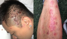 Căn bệnh vẩy nến ca sĩ Tuấn Hưng mắc phải nguy hiểm như thế nào?