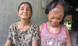 Nghẹn lòng ước mơ của bé gái bị tình địch của mẹ tạt a-xít mù hai mắt