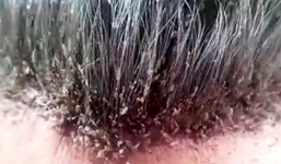 Cười ra nước mắt cảnh người đàn ông dùng thuốc trừ sâu để diệt chấy trên đầu