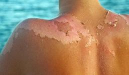 Điểm mặt triệu chứng bệnh thường gặp mùa hè: Số 8 rất dễ phát triển thành ung thư