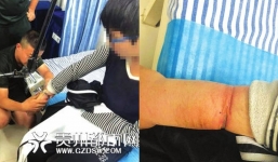 Tự đeo còng suốt 1 năm rồi mặc áo dài tay để giấu gia đình, cậu bé 14 tuổi bị chấn thương nghiêm trọng tới biến dạng cánh tay