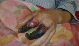 Bị 1 vết xước nhỏ, 8 ngày sau người đàn ông hoại tử 2 ngón tay đen xì, cận kề cửa tử