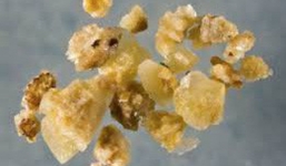 Bé 2 tuổi, 5 tuổi đã bị sỏi thận: Chuyên gia chỉ mặt nguyên nhân rất phổ biến