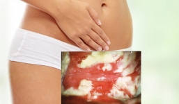 Chuyên gia sản khoa vạch mặt 'thủ phạm' gây vô sinh chị em không ngờ tới