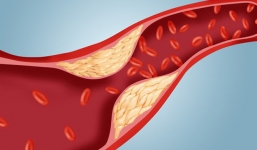 'Công thức vàng' làm sạch mạch máu, giảm mỡ máu: Bài thuốc nên có trong mọi gia đình