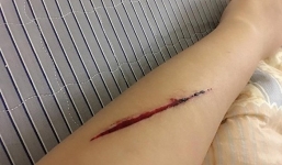 Sự thật tin cô gái bị rạch tay cướp ở đường Láng xôn xao MXH